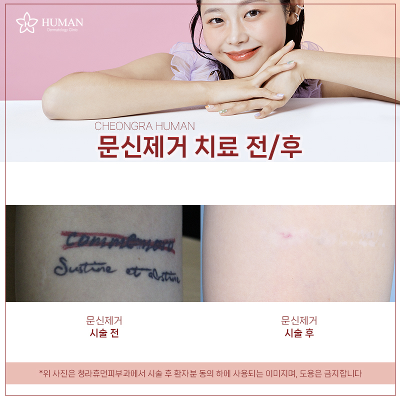 청라휴먼피부과 : 문신 제거 Before&Aft