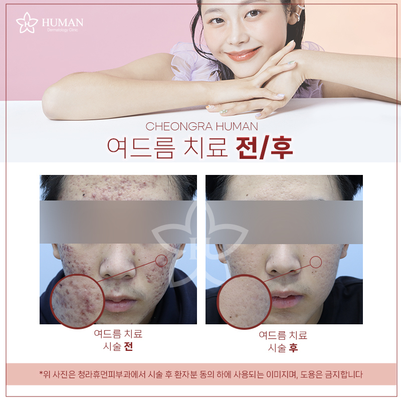 청라휴먼피부과 : 여드름 치료 Before&Af