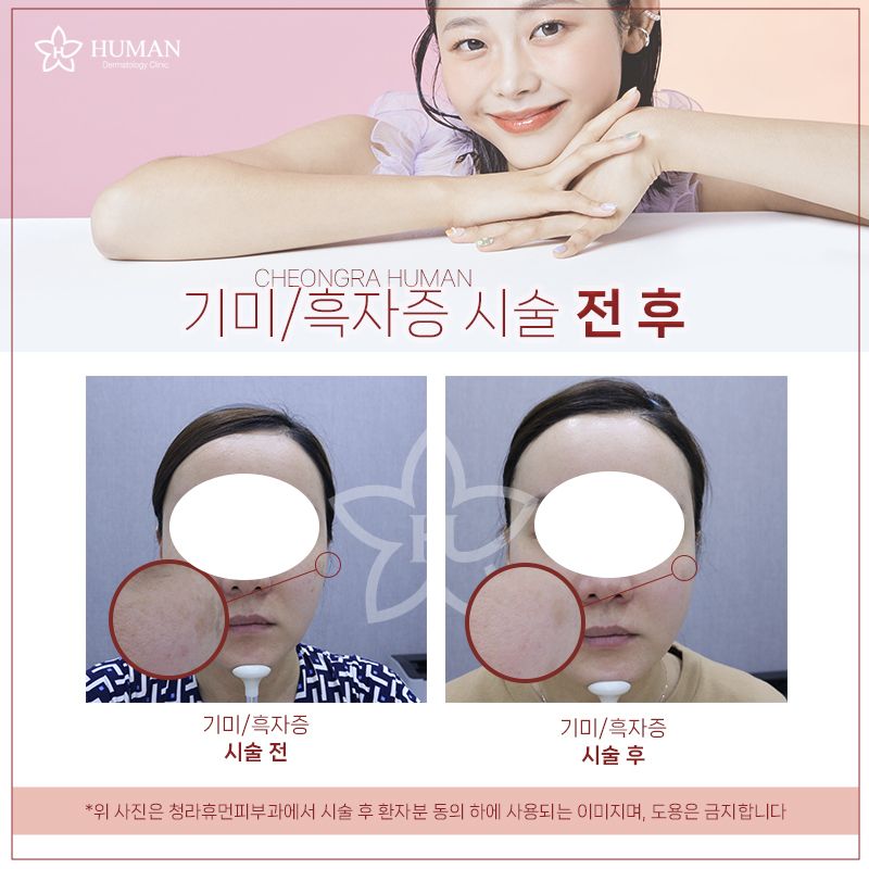 청라휴먼피부과 : 기미/흑자치료 Before&A