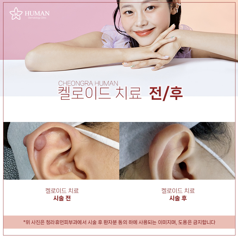 청라휴먼피부과 : 켈로이드 치료 Before&A