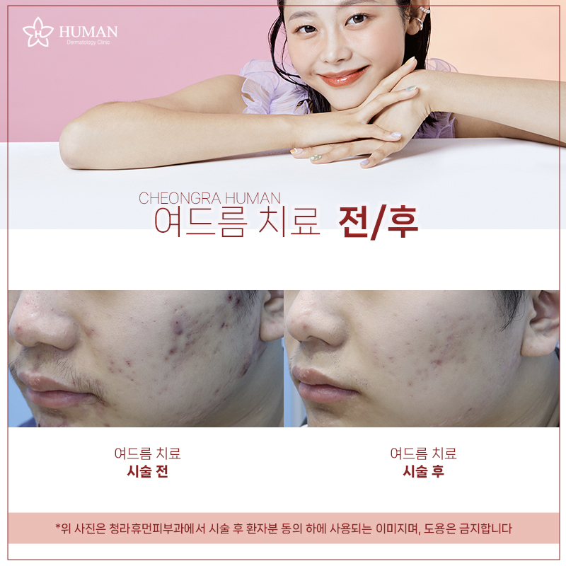 청라휴먼피부과 : 여드름 치료 Before&Af