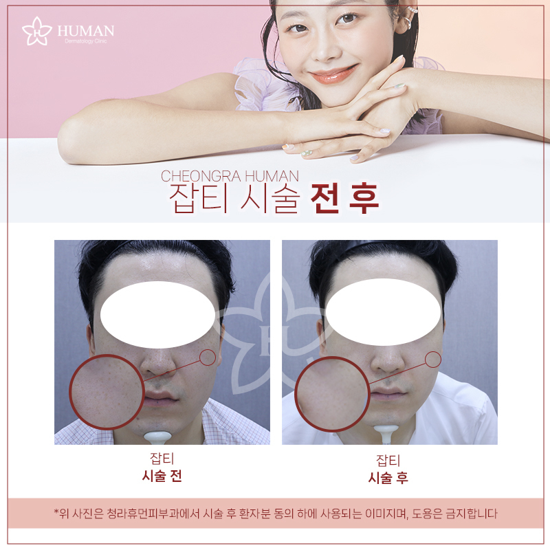 청라휴먼피부과 : 잡티 제거 Before&Aft