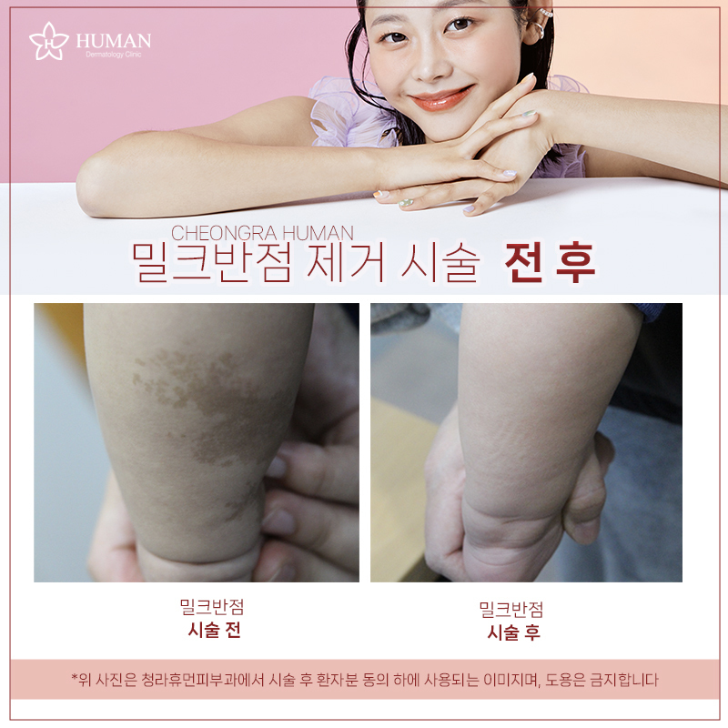 청라휴먼피부과 : 밀크반점 Before&Afte