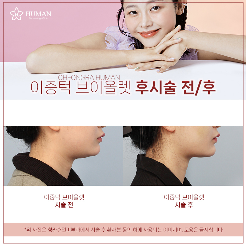 청라휴먼피부과 : 이중턱 바이올렛 Before&