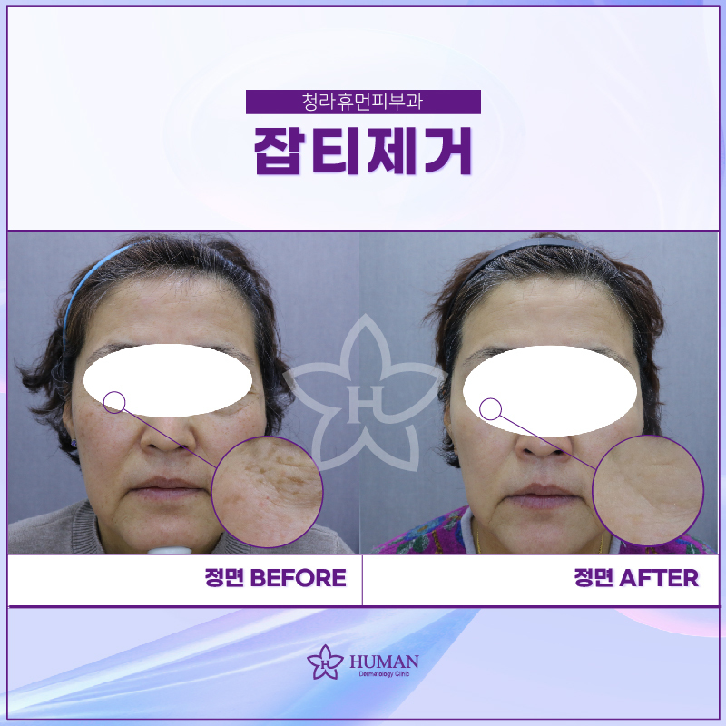청라휴먼피부과 : 잡티 제거 Before&Aft