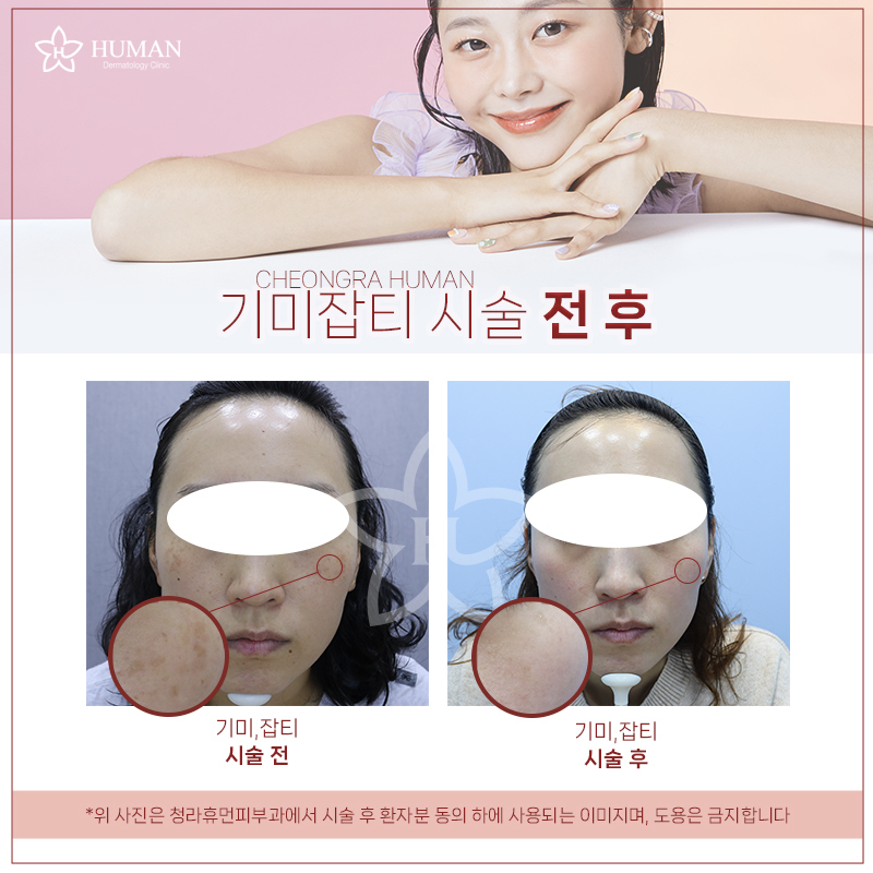 청라휴먼피부과 : 기미,잡티 제거 Before&