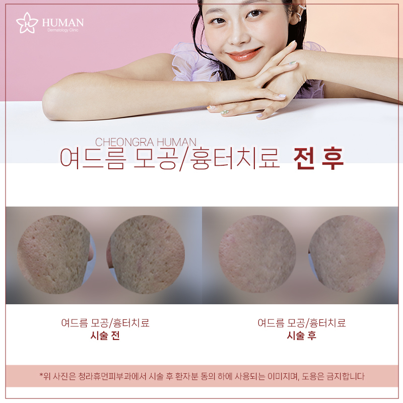 청라휴먼피부과 : 여드름흉터/모공치료 Before&am
