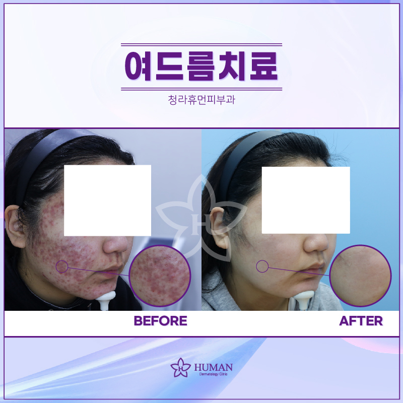 청라휴먼피부과 : 여드름 치료 Before&Af
