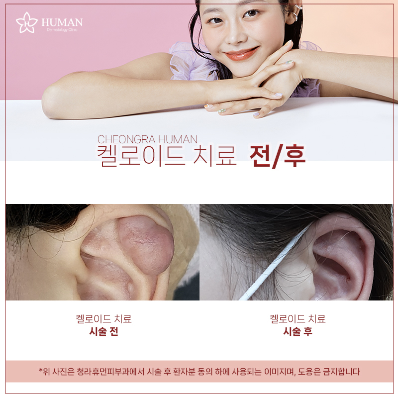 청라휴먼피부과 : 켈로이드 치료 Before&A