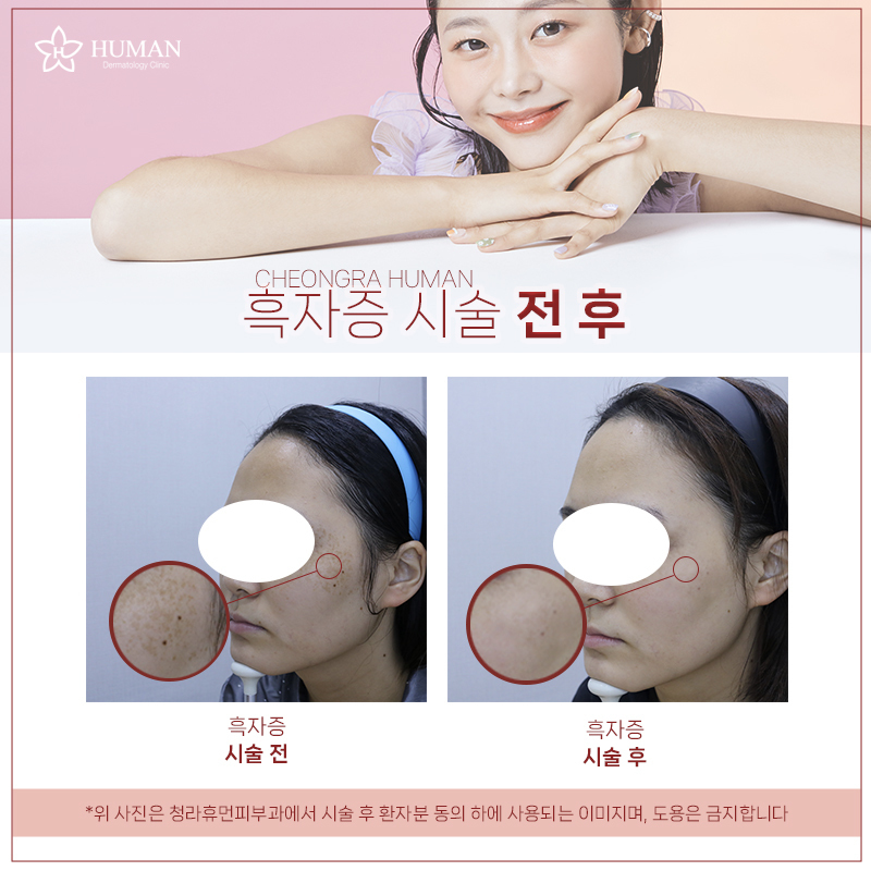 청라휴먼피부과 : 흑자증 Before&After