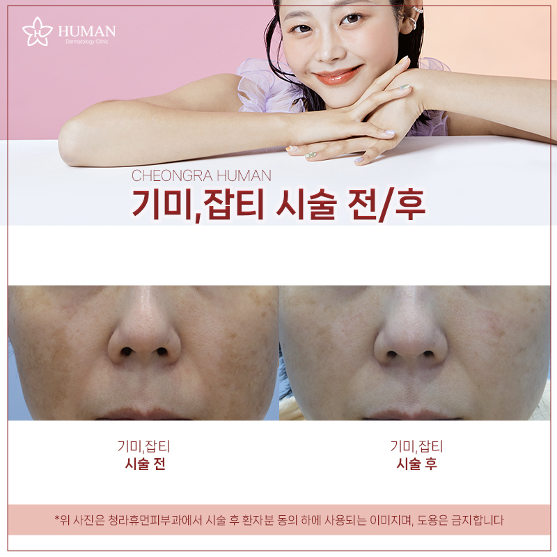 청라휴먼피부과 : 기미잡티 제거 Before&A