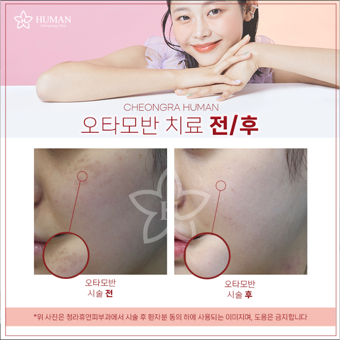 청라휴먼피부과 : 오타모반 치료 Before&A