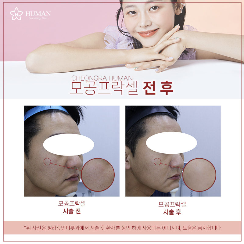 청라휴먼피부과 : 모공치료 Before&Afte