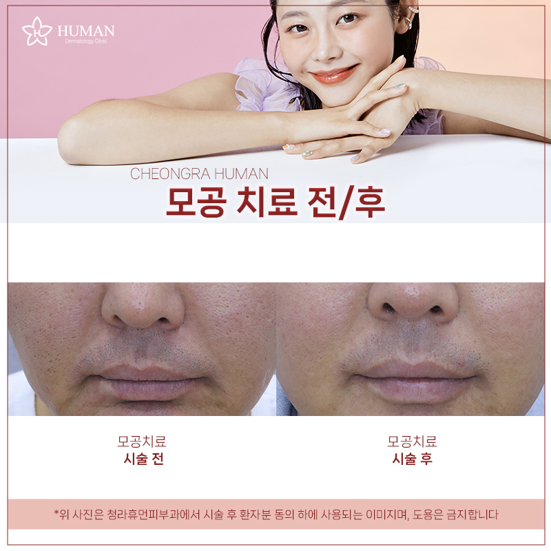 청라휴먼피부과 : 모공치료 Before&Afte