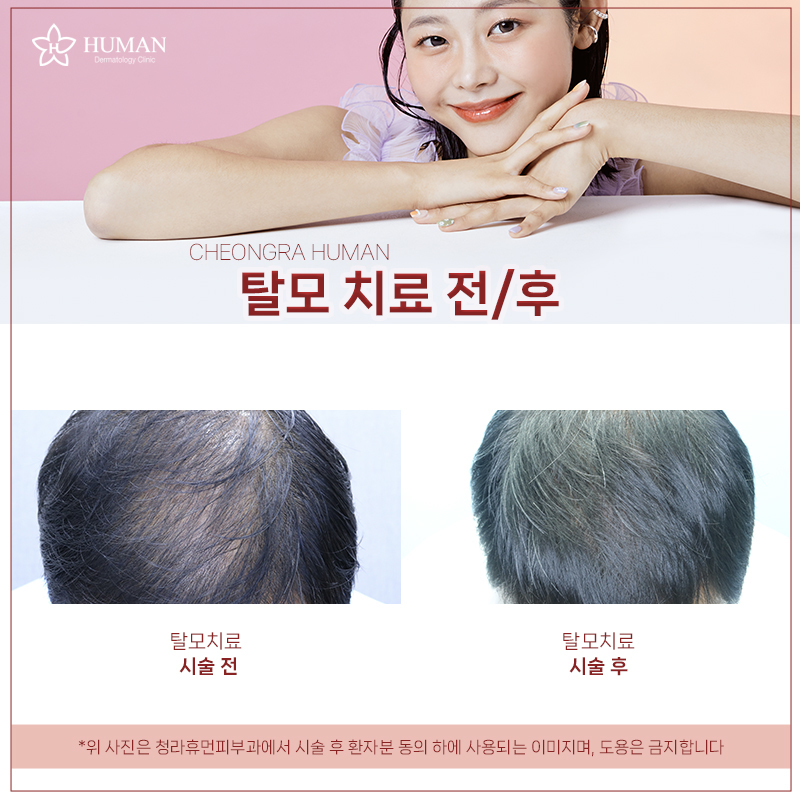 청라휴먼피부과 : 탈모치료 Before&Afte