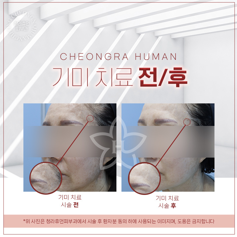 청라휴먼피부과 : 기미 치료 Before&Aft