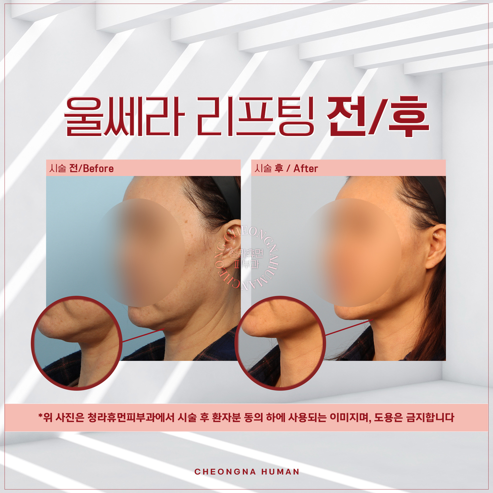 청라휴먼피부과 : 울쎄라 리프팅  Before&